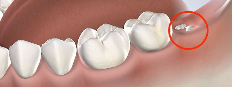Răng khôn là gì? Có nên nhổ răng khôn hay không?